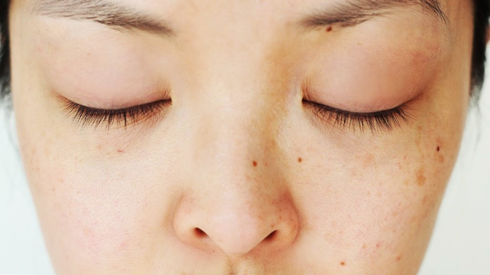 dark spots on skin