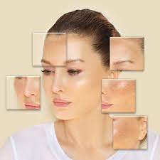 Post-Inflammatory Hyperpigmentation Skin discoloration Skin imperfections Redness on face uneven skin tone