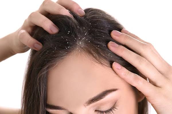dry scalp vs. dandruff 