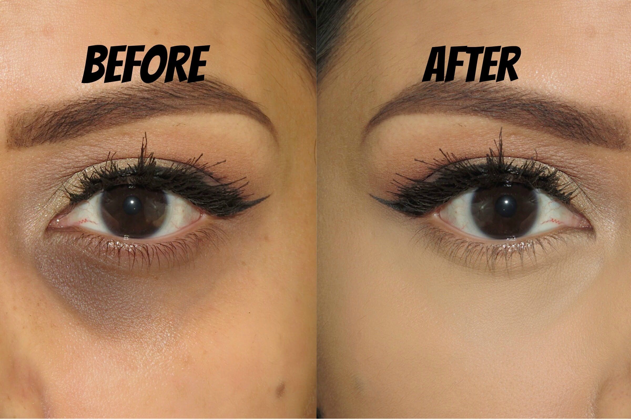 dark circles under the eyes before after