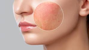 makeup removal closeup of skin 